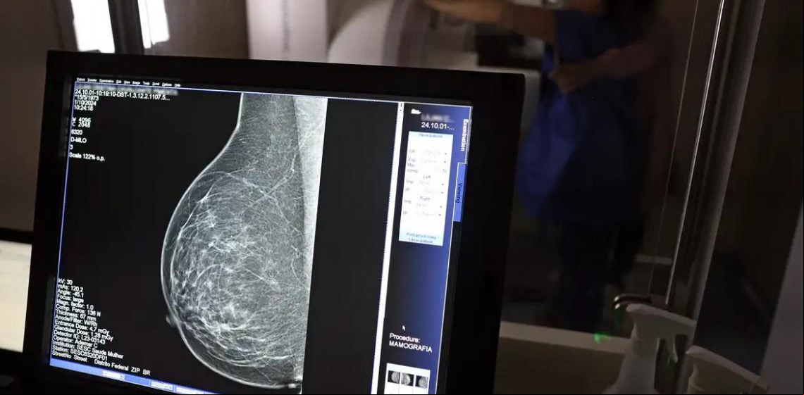 Câncer de mama: Uma em cada três pacientes tem menos de 50 anos