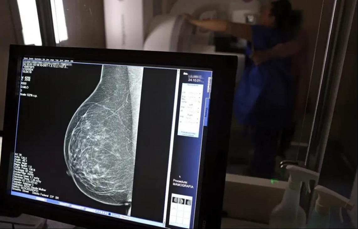 Câncer de mama: Uma em cada três pacientes tem menos de 50 anos